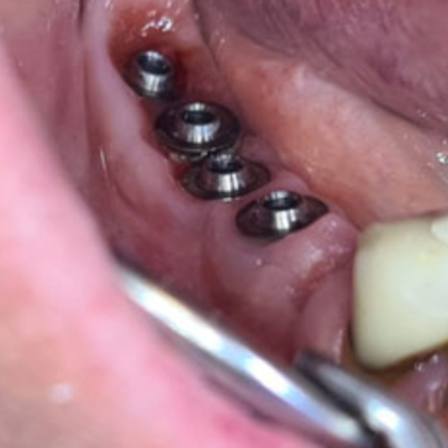 New Bridge made easy thanks to the screw retained system