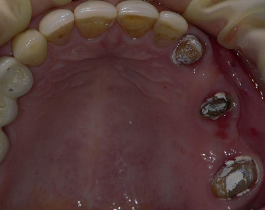 Occlusal view of upper dental arch showing missing molars and stained anterior teeth