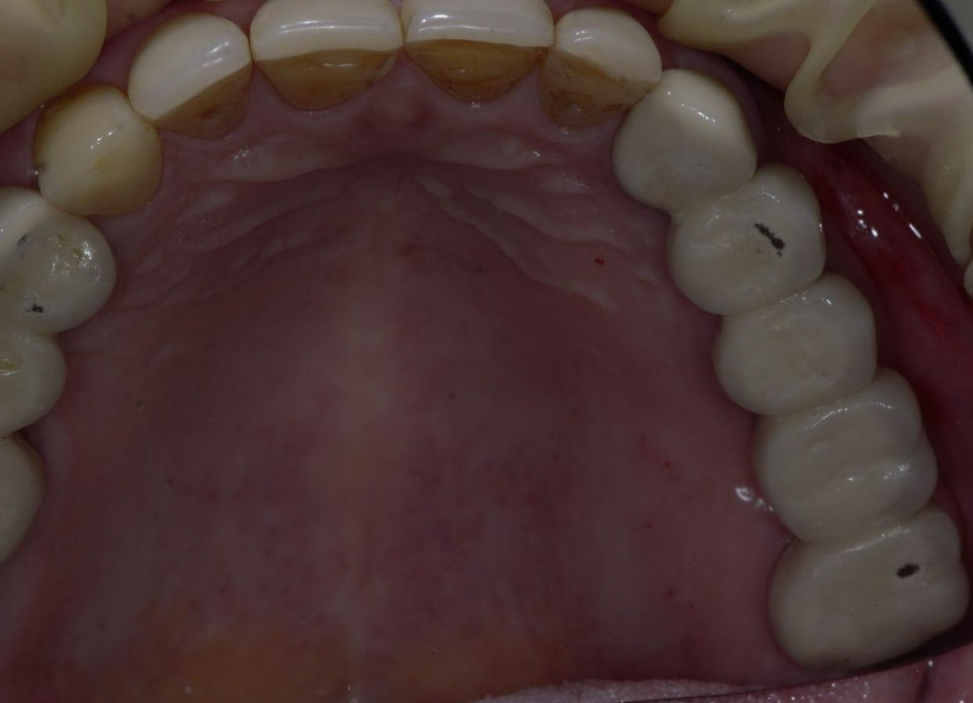 Occlusal view of upper dental arch showing tooth staining on anterior teeth