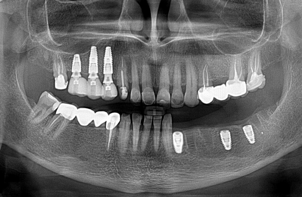 Panoramic dental x-ray showing multiple implants in upper and lower jaw with crowns