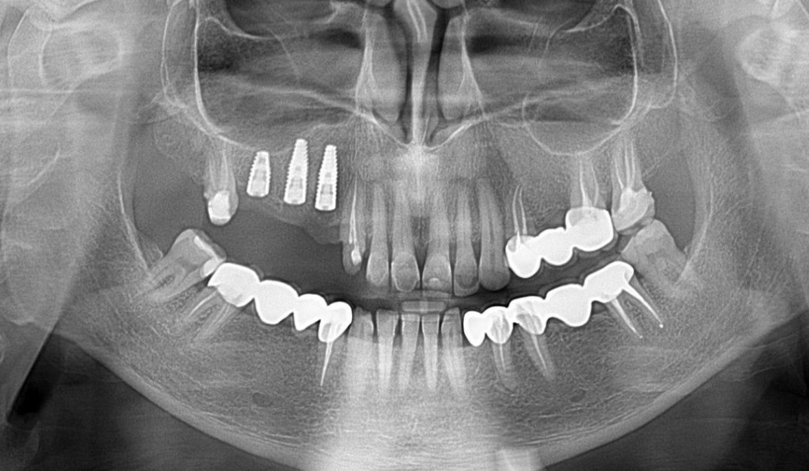 Panoramic dental x-ray showing multiple dental implants in upper jaw and crowns throughout mouth