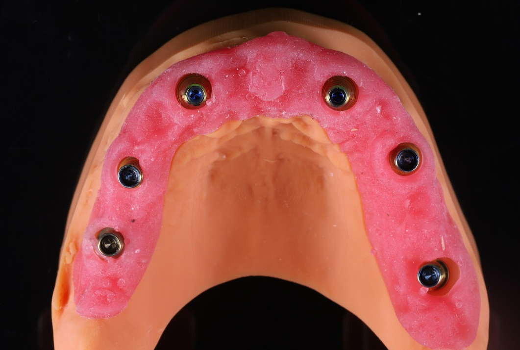 Finished polished upper dental implant supported denture with pink acrylic and metal abutment attachments