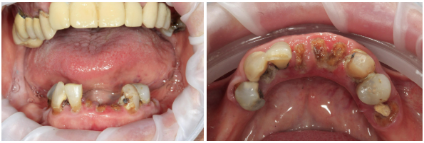 Two intraoral photos showing the challenging preoperative condition of the patient’s mandible, with failing teeth and a removable partial denture.