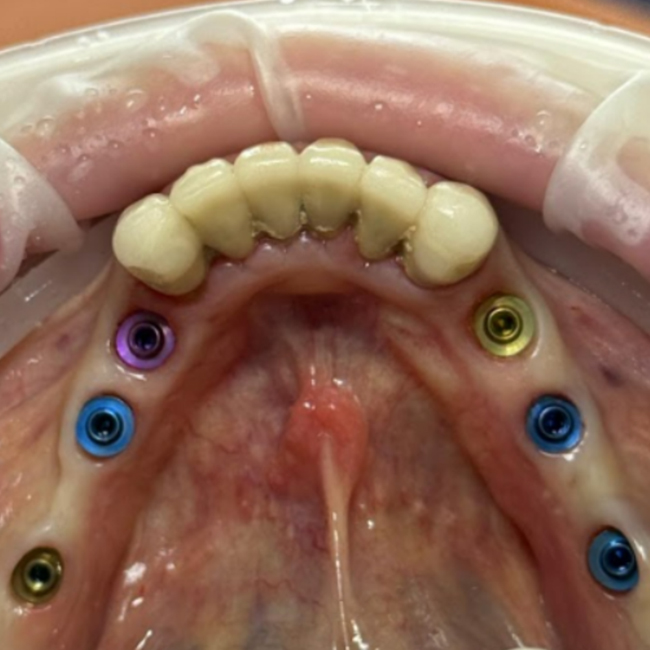 Replacement of a Removable Denture with a Permanent Implant-Supported Restoration: Screw Retention on MUA V-Type XGATE Dental