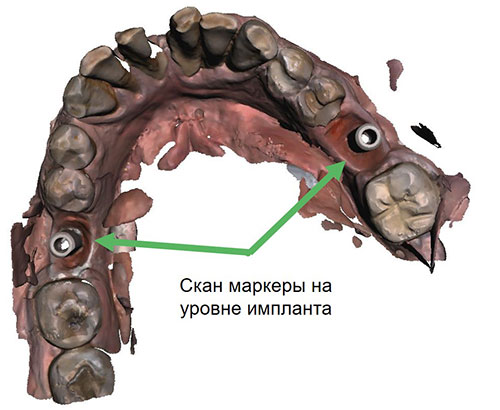 Scan markers at the implant level fitted on 36 and 46m teeth