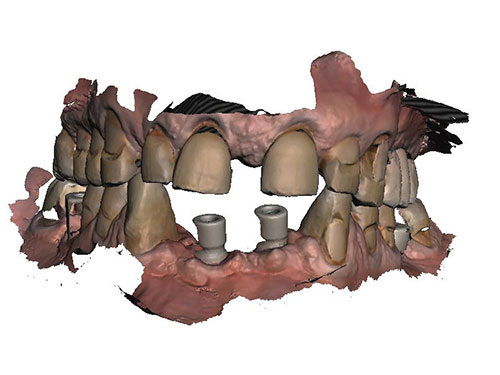 Bite scan