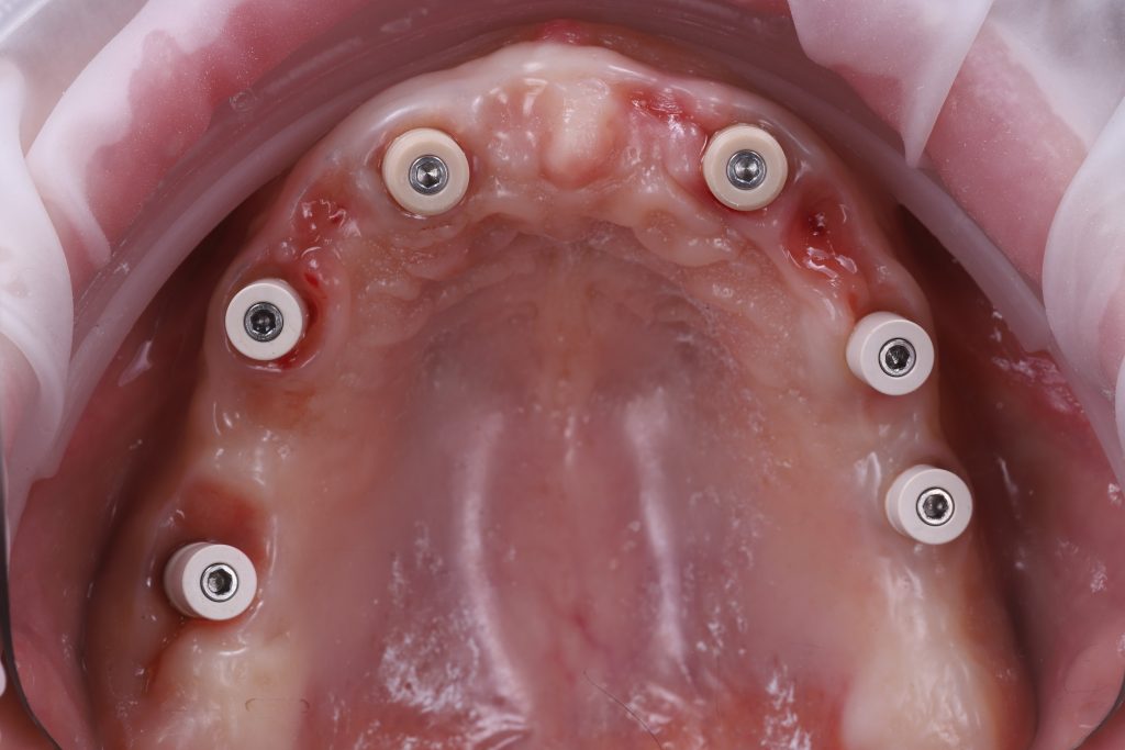 Six scan bodies seated on multi-unit abutments in maxillary arch, ready for intraoral digital scanning