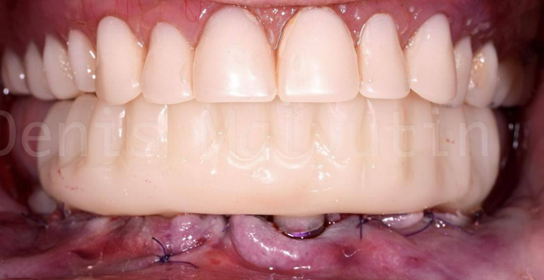 Final screw-retained dental prosthesis on lower jaw showing completed restoration with natural appearance
