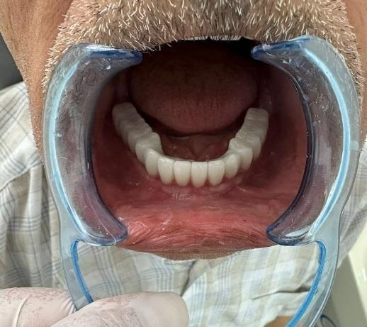 View of the mandibular prosthesis with sealed screw access holes.
