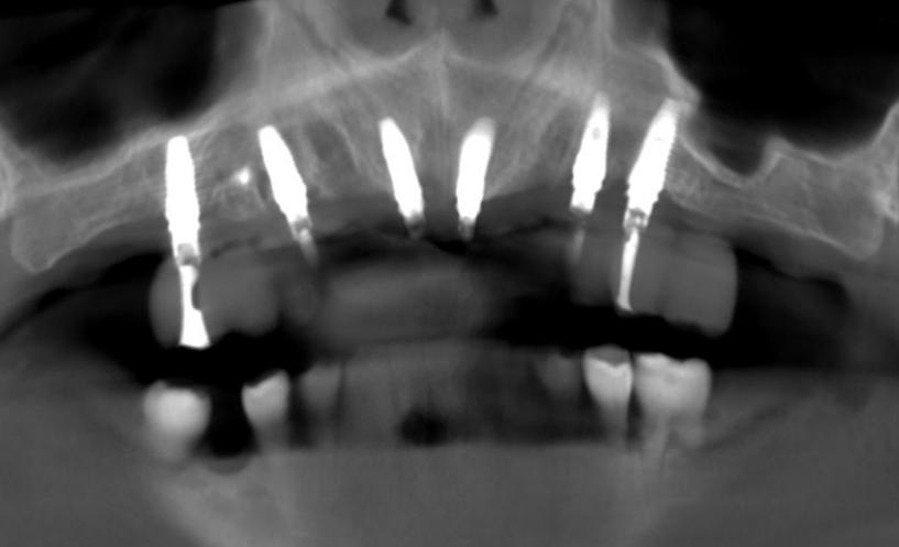 Six Neobiotech standard-diameter dental implants placed in maxilla for full-arch restoration with immediate loading protocol