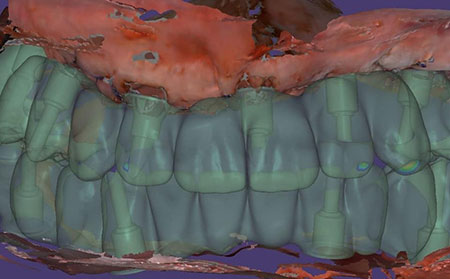 Teeth extraction and implantation for immediate loading