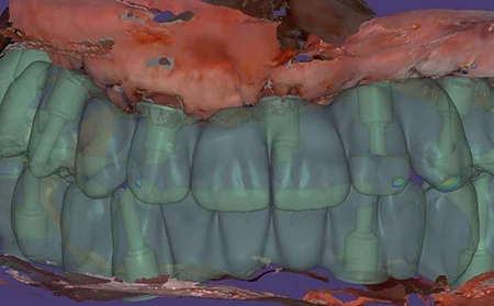 Teeth extraction and implantation for immediate loading