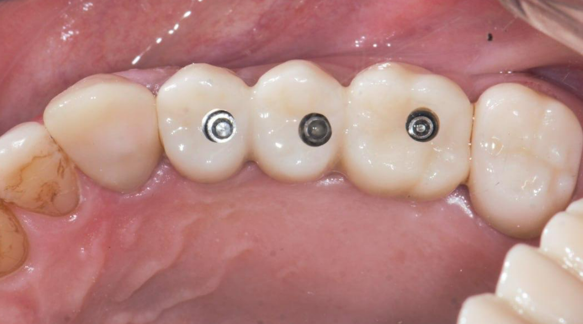 Three dental implant crowns with visible screw access holes on occlusal surface of upper arch