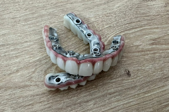 Intaglio view of the full-arch prostheses showing the titanium framework and screw access channels.