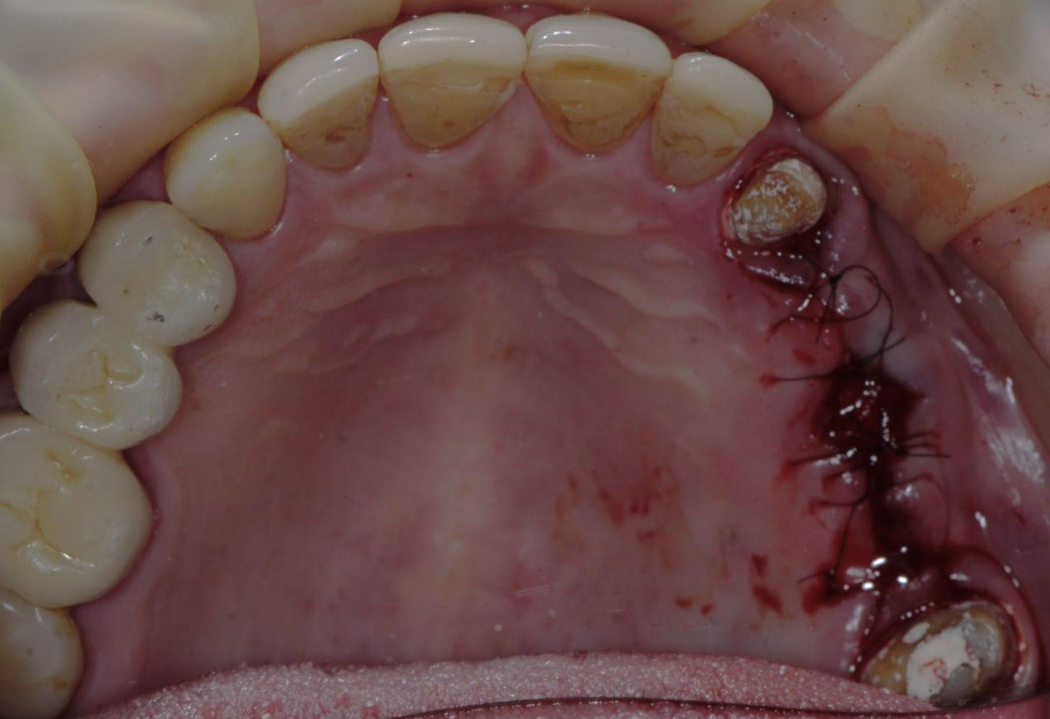 Occlusal view of upper dental arch showing healing abutments and sutures after implant surgery