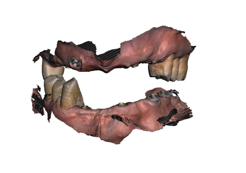 Use of an incorrectly placed implant by using Multi-Unit V-Type and 1.5mm sleeve