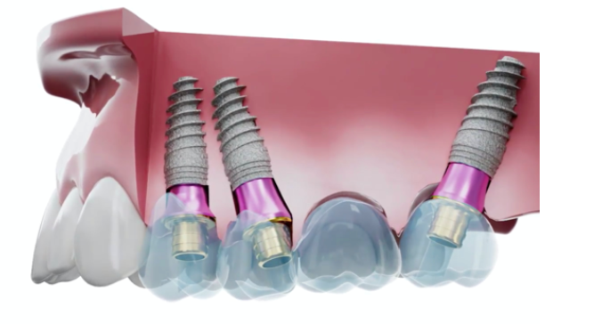 3D render of divergent posterior implants restored on V-Type multi-unit abutments without angled components.