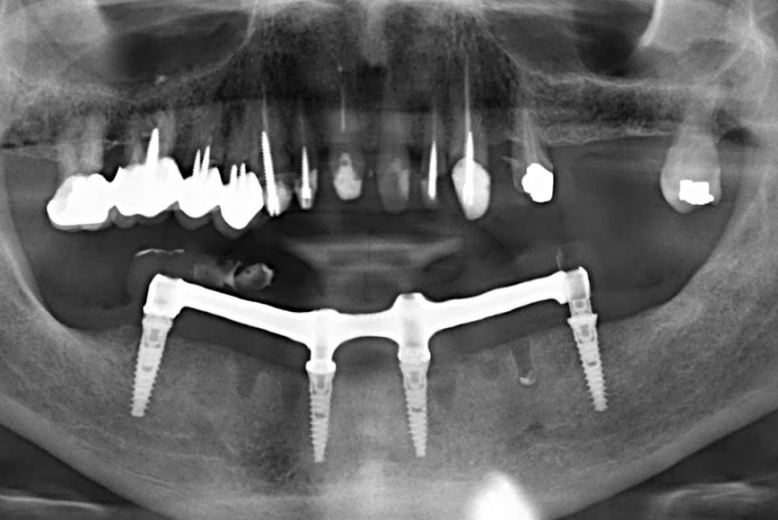 A panoramic radiograph showing the initial milled titanium bar which did not fit properly on the implants due to an inaccurate first impression.