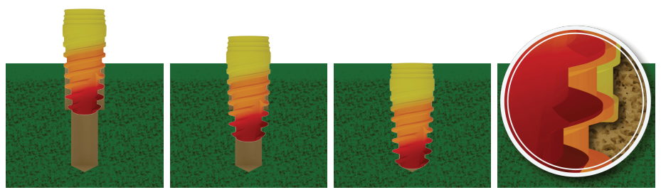 Diagram of the cone-like XGATE implant gradually compressing bone during insertion into the osteotomy.