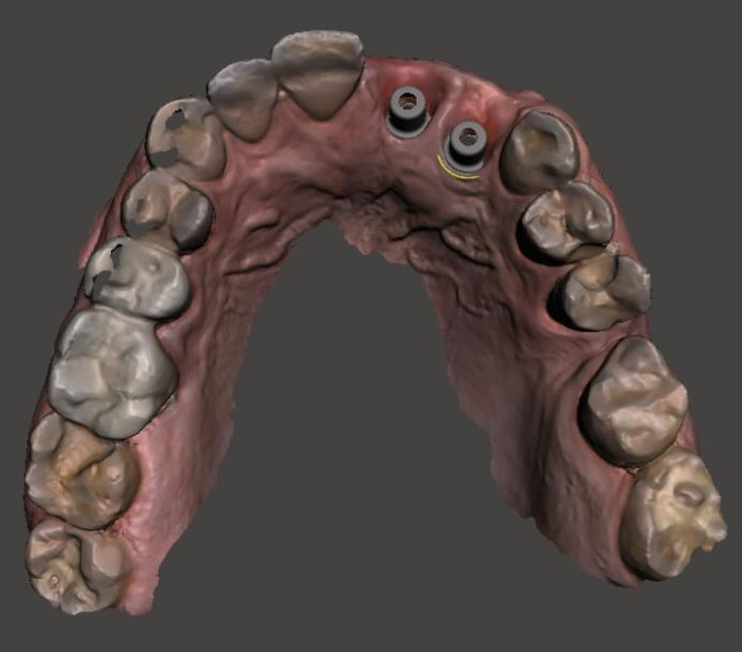 3D image of the upper jaw with implants placed: it is visible that both implants are displaced palatally