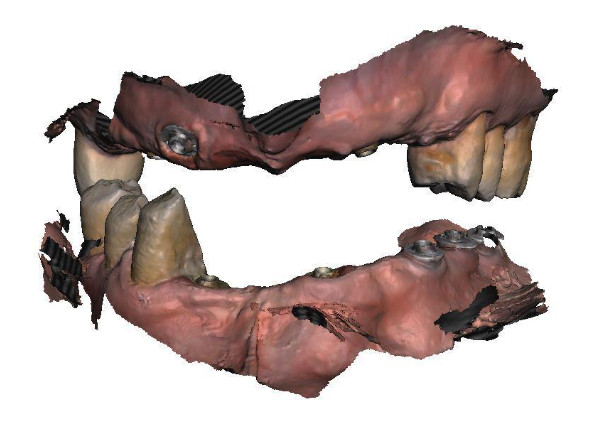 3D model of the upper and lower jaw with installed MUA V-type