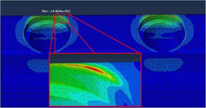 Finite element analysis showing four areas of interest in marginal bone with maximum predicted stress of 96.94 MPa