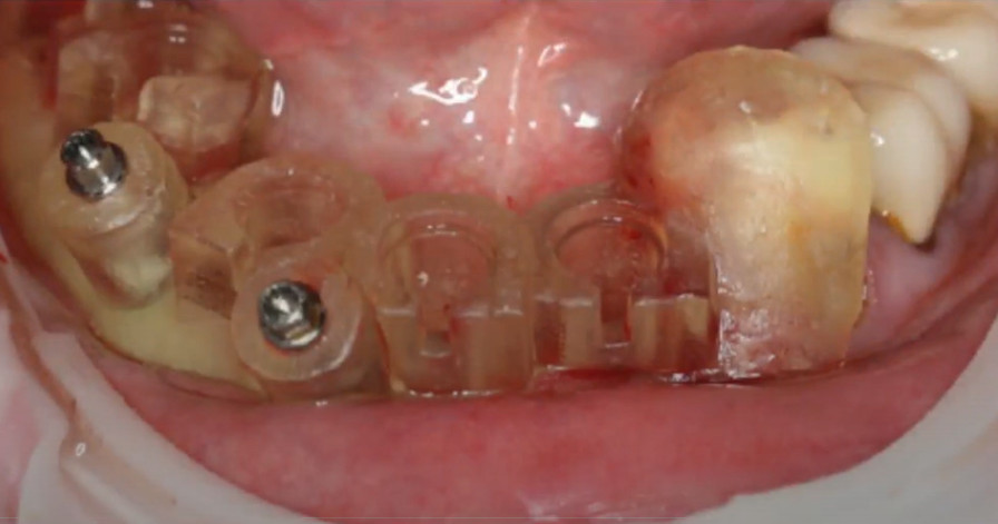 A digitally designed and 3D printed individual surgical template for precise positioning of implants including the position of the internal interface edgesYouTube / Dr. Kamil Khabiev / Dental Guru Academy