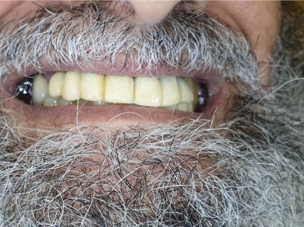 Smile with daily use of new bridges, patient's wishes fulfilled