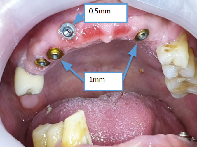 Angled multi-unit abutment D-type: in this case the entire part where the marking is applied would be visible