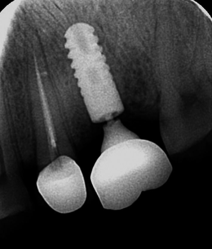 Clinical photograph showing simultaneous fracture at abutment neck and central screw in Morse taper implant system