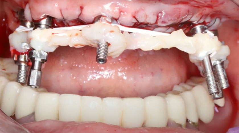 Combining transfers into a single structure to provide mechanical strength before taking an impression YouTube / Dr. Kamil Khabiev / Dental Guru Academy
