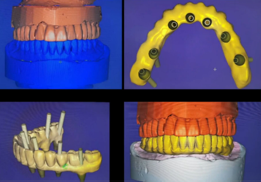 Design of a complete lower jaw denture incorporating the previously installed and two new implants YouTube / Dr. Kamil Khabiev / Dental Guru Academy