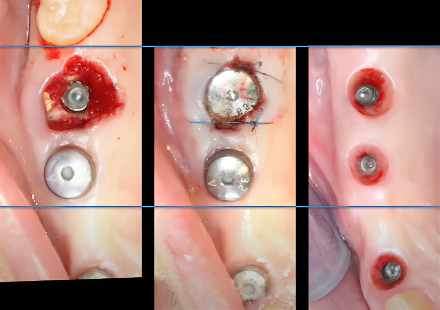 Immediate implant placement following molar extraction YouTube / Dr. Kamil Khabiev / Dental Guru Academy