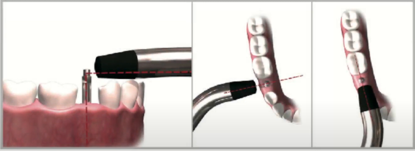 Measuring Primary Implant Stability Using Resonance Frequency Analysis (RFA) YouTube / Dr. Kamil Khabiev / Dental Guru Academy
