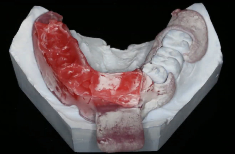 Model of a patient's jaw with a wax bite block YouTube / Dr. Kamil Khabiev / Dental Guru Academy
