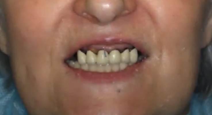 Patient with a failing RPD: poor appearance and compromised function YouTube / Dr. Kamil Khabiev / Dental Guru Academy
