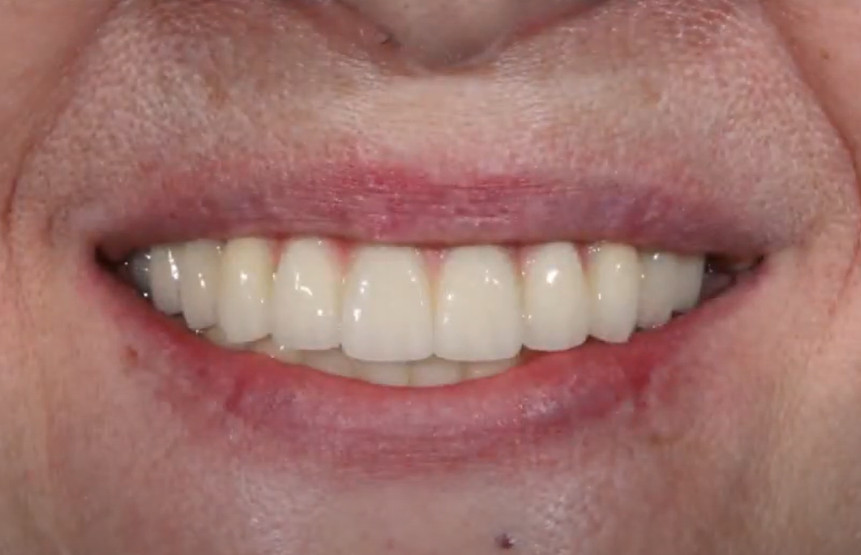 Permanent restoration with excellent aesthetic results YouTube / Dr. Kamil Khabiev / Dental Guru Academy