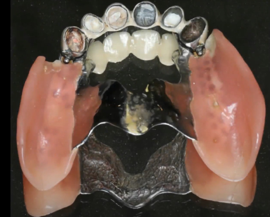 RPD after three years of use YouTube / Dr. Kamil Khabiev / Dental Guru Academy