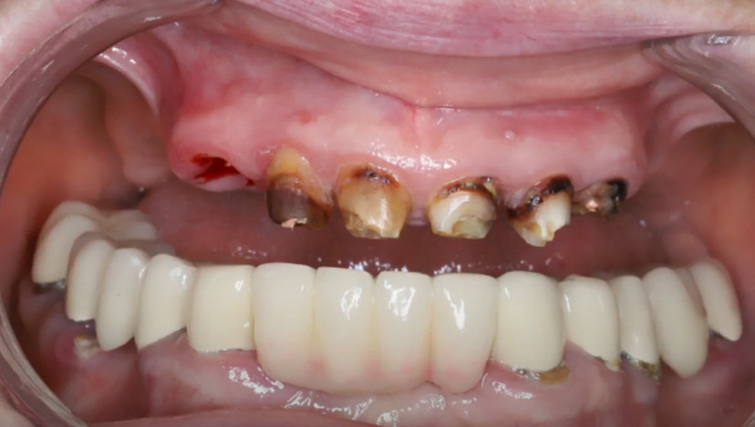 Severely damaged teeth resulting from RPD wear YouTube / Dr. Kamil Khabiev / Dental Guru Academy
