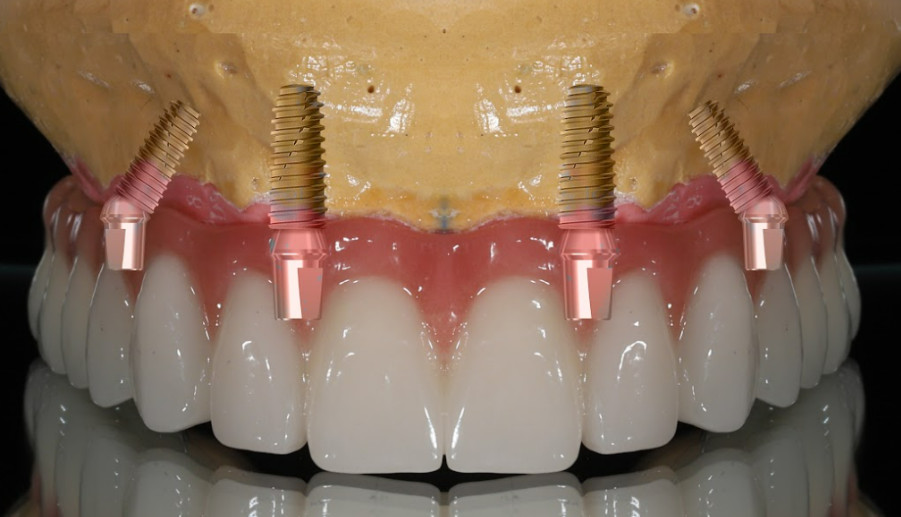 Straight and angled abutments in the restoration of a full arch according to the All-on-4 protocol (image from shutterstock)