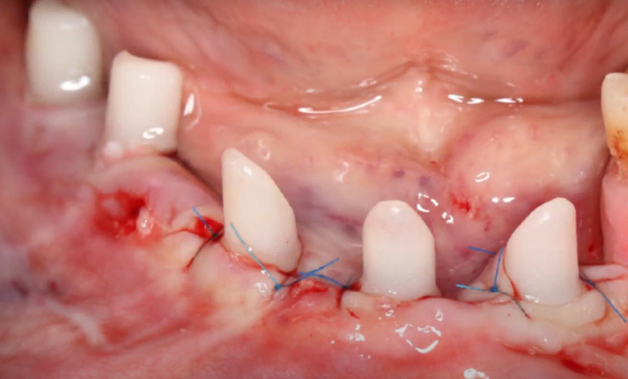 Temporary abutments and sutured soft tissues immediately after implant placement YouTube / Dr. Kamil Khabiev / Dental Guru Academy