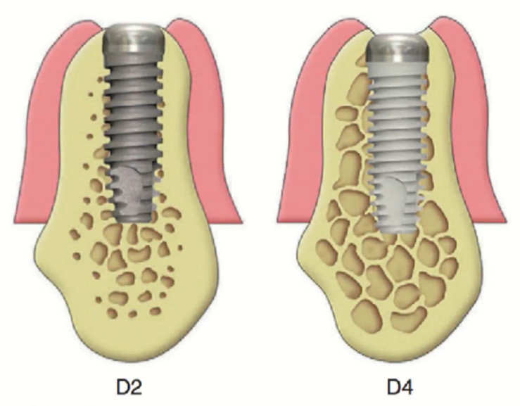 The difference in implant contact area in varying bone densities (in D2 bone, the contact area of ​​titanium with bone is much larger) YouTube / Dr. Kamil Khabiev / Dental Guru Academy