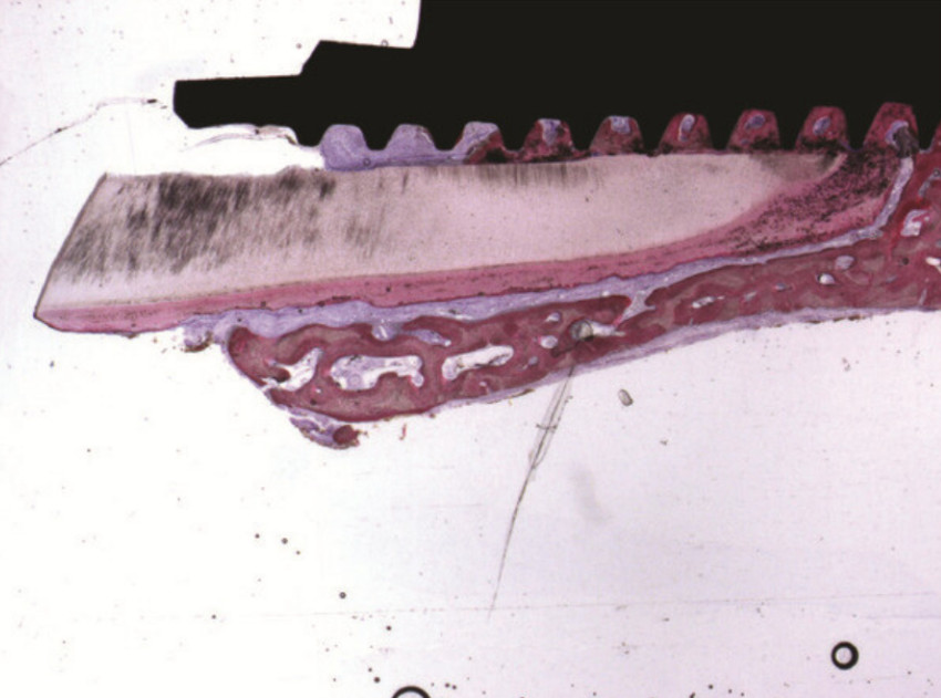 Trabecular, mature bone at the interface of the implant was observed. The bone was present between the implant and the root. The root membrane and the buccal bone plate appeared intact without any signs of resorption. Acid fuchsin-toluidine blue 12x. YouTube / Dr. Kamil Khabiev / Dental Guru Academy