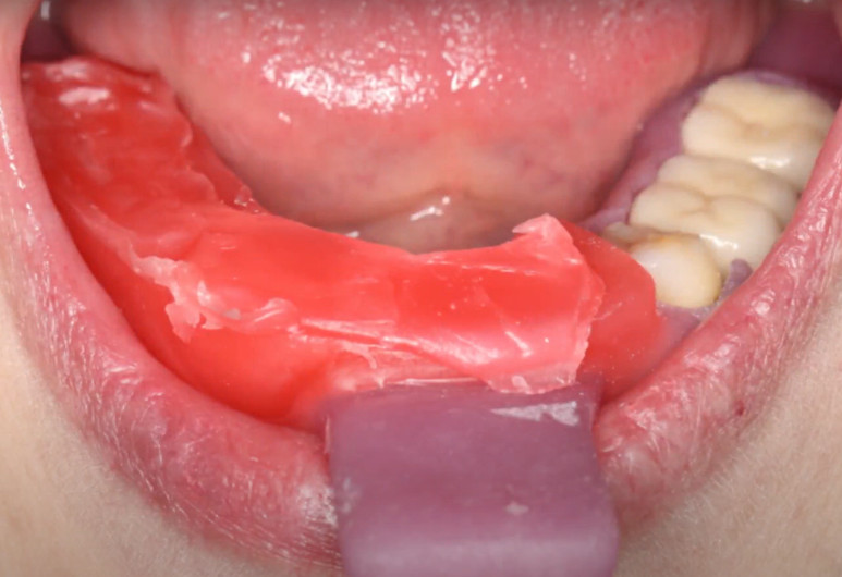 Wax bite roller for fixing the central relationship of the jaws YouTube / Dr. Kamil Khabiev / Dental Guru Academy