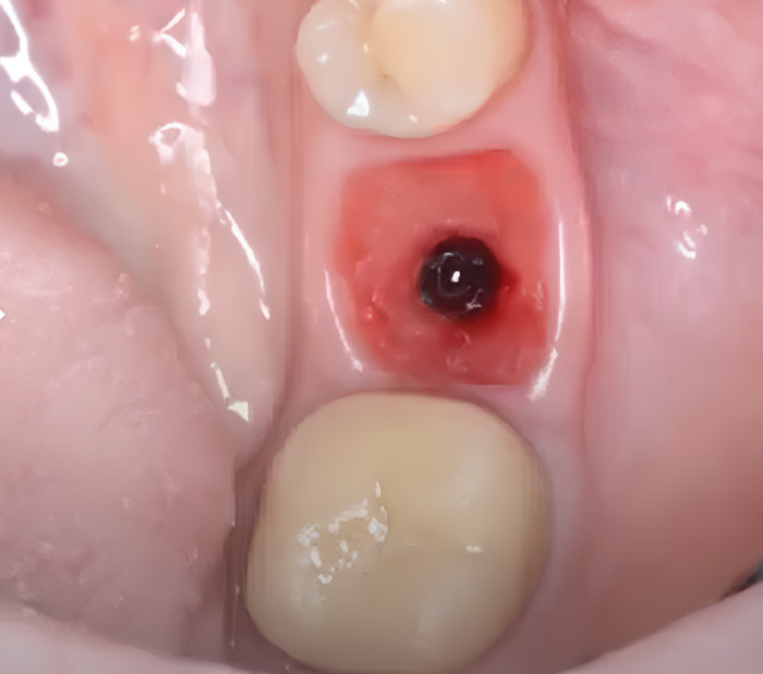 Well-formed gingiva prepared for restoration YouTube / Dr. Kamil Khabiev / Dental Guru Academy