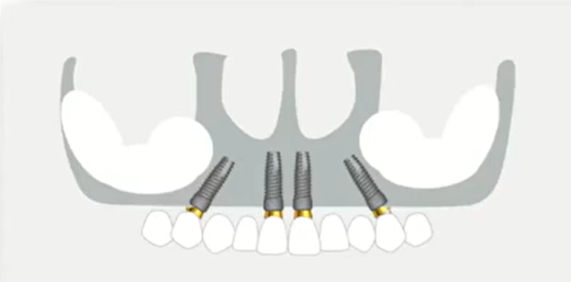 Fixed prosthesis diagram for the full-arch on 4 implant protocol