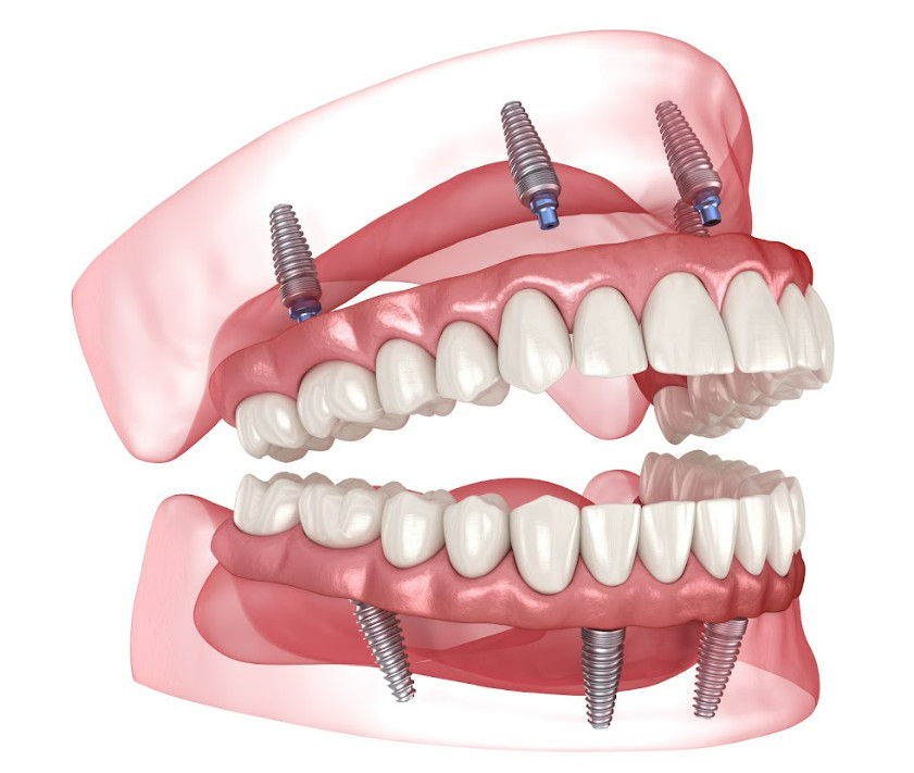 One option for placing implants in the All‑on‑4 prosthetic protocol