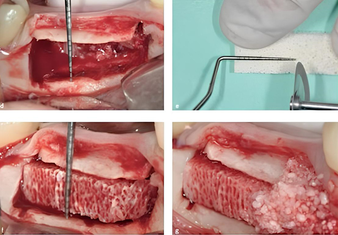 Surgical procedure showing xenogeneic bone block placement for alveolar ridge height augmentation with surgical instruments