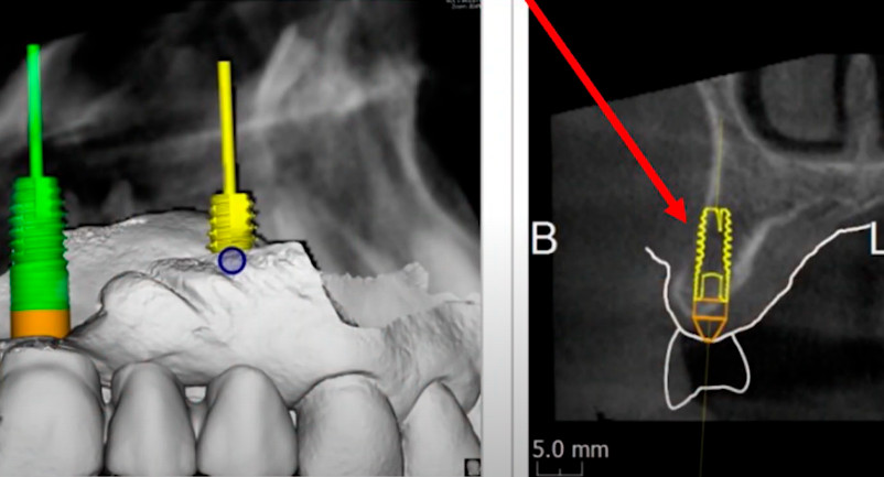 Dental implant placement showing potential fenestration in narrow alveolar ridge