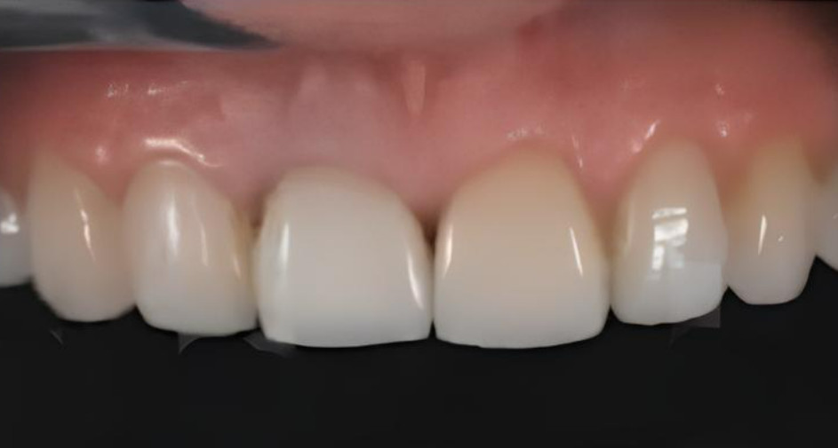 Frontal view of the completed smile after placement of veneers and the new crown on tooth 11.